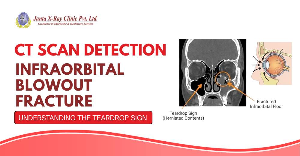 CT Scan Detection of an Infraorbital Blowout Fracture: Understanding the Teardrop Sign